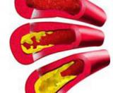 Неожиданное открытие против атеросклероза