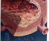 Существует другой метод для очистки тела от холестерина