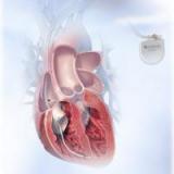 Дефибрилляторы влияют на умственные способности пациентов