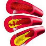 Стволовые клетки костного мозга ускоряют развитие атеросклероза