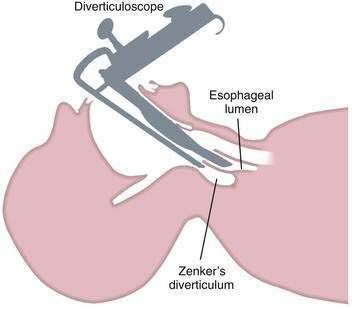  Впервые в Армении в МЦ &laquo;Наири&raquo; выполнена трансоральная операция по устранению дивертикула пищевода