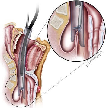  Впервые в Армении в МЦ &laquo;Наири&raquo; выполнена трансоральная операция по устранению дивертикула пищевода
