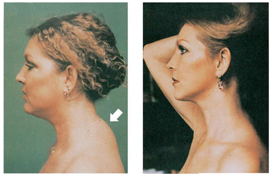 &laquo;Вдовий горбик&raquo; &mdash; жировые (или мышечные) шишки на спине у шеи