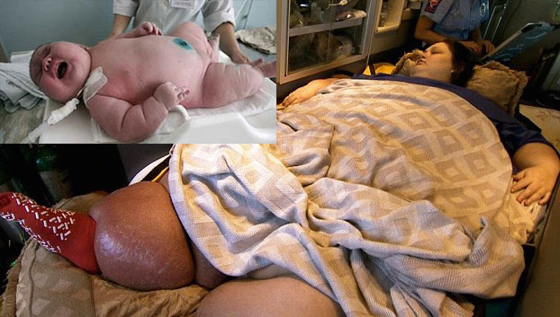 Вы можете себе представить, что женщина весом 272 кг дает жизнь ребенку весом 18 кг? Если нет, вы должны это прочитать! Врачи абсолютно не были готовы к такому гигантскому ребенку, но так или иначе сумели принять его, и малыш...## вполне здоров!  Женщина весом в 272 кг родила малыша весом в 18 кг в больнице Perth&rsquo;s King Edward Memorial. Новорожденный может стать крупнейшим из всех детей, когда-либо появлявшихся на свет.  Ребенок огромного размера стал сюрпризом для врачей и медсестер, которые не были готовы к такому случаю.  Ребенок-гигант потряс медиков, агентство ООН совершенно не было готово к такому инциденту, однако отмечает, что сотрудники больницы отлично справились с принятием родов этого ребенка, и малыш абсолютно здоров. Рейтинг больницы значительно вырос.   Сенсация: женщина весом в 272 кг родила ребенка весом в 18 кг!	  	
