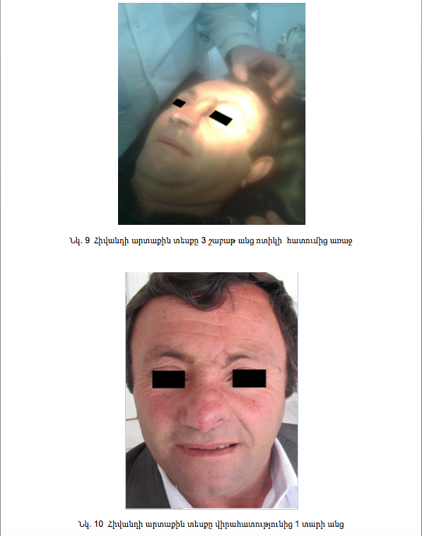 Քթի ծայրային արատի վերականգնում պարամեդիալ ճակատային լաթով